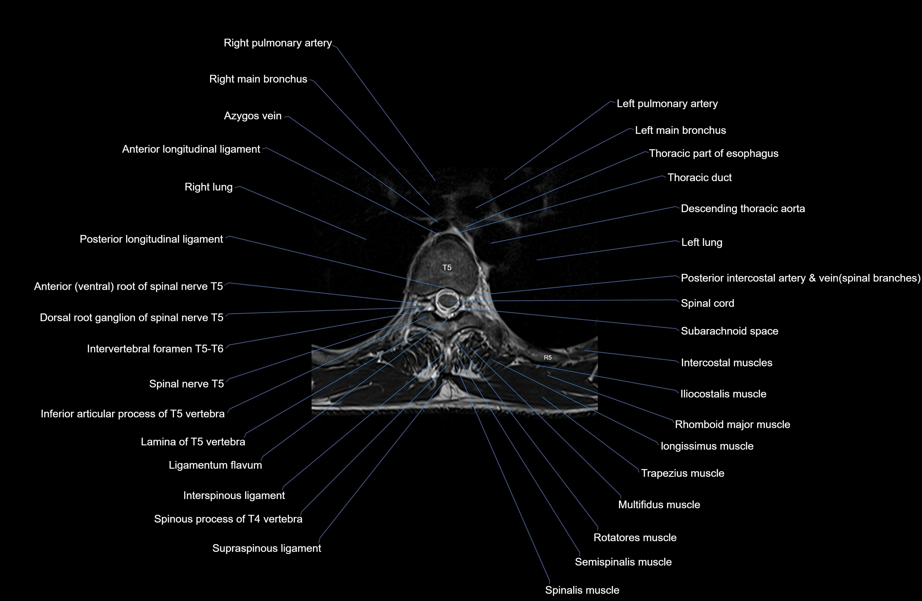 MRI thoracic spine axial  cross sectional anatomy 3T radiology  image-img-00001-00033.webp